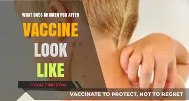 Chickenpox Post-Vaccination: Symptoms, Appearance, and What to Expect