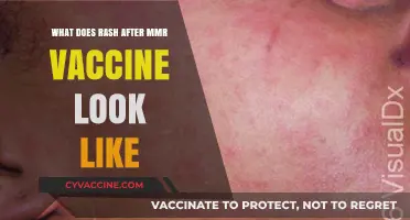 MMR Vaccine Rash: Appearance, Symptoms, and What to Expect