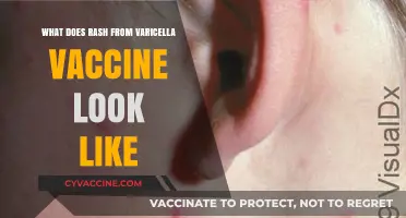 Varicella Vaccine Rash: Appearance, Symptoms, and What to Expect