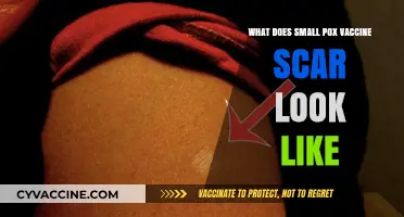 Smallpox Vaccine Scar Appearance: What to Expect and How It Looks