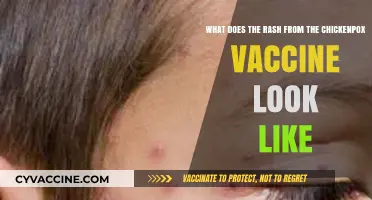 Chickenpox Vaccine Rash: Appearance, Symptoms, and What to Expect