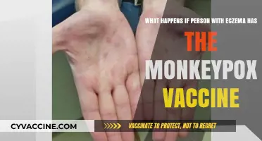 Eczema and Monkeypox Vaccine: Potential Risks and Precautions Explained