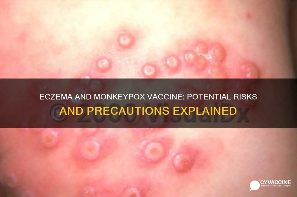 what happens if person with eczema has the monkeypox vaccine