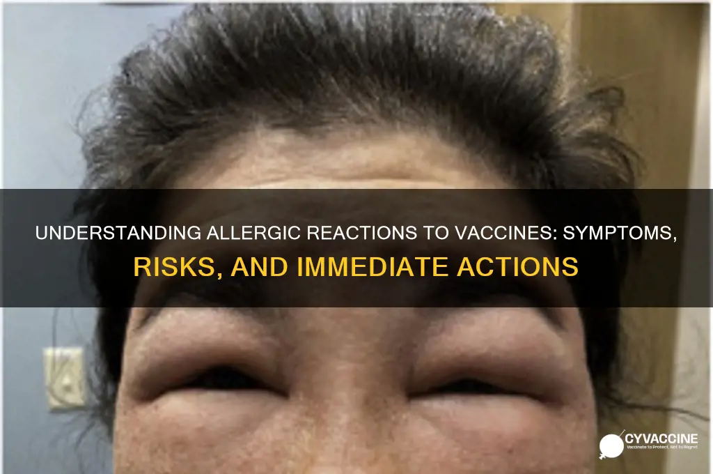 what happens if you have an allergic reaction to vaccine
