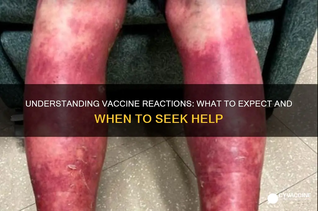 what happens if you react to the vaccine