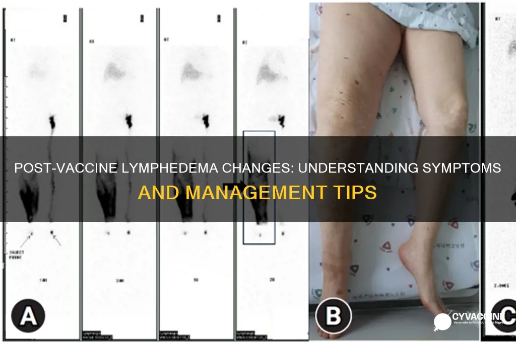 what is a change of lymphedema after vaccine