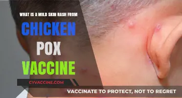 Understanding Mild Skin Rashes Post-Chickenpox Vaccination: Causes and Care
