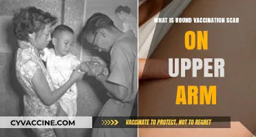 Understanding the Round Vaccination Scar on Your Upper Arm