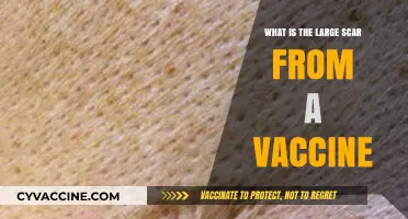 Understanding the Large Scar from Vaccines: Causes and Concerns