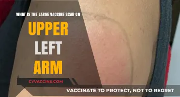 Understanding the Large Vaccine Scar on Your Upper Left Arm
