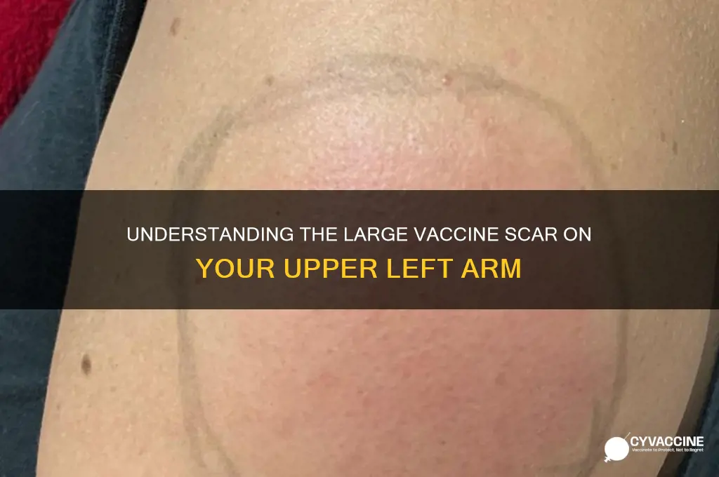 what is the large vaccine scar on upper left arm