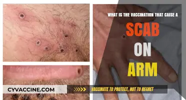 Understanding the Smallpox Vaccine: Why It Causes a Scab on Your Arm