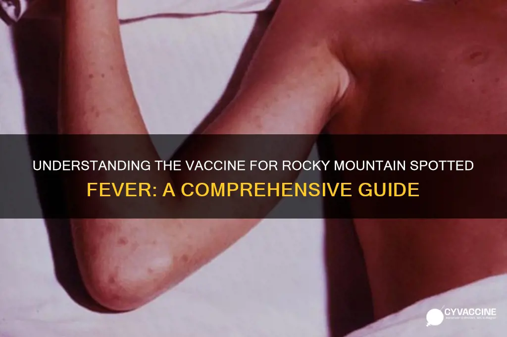 what is the vaccine for rocky mountain spotted fever