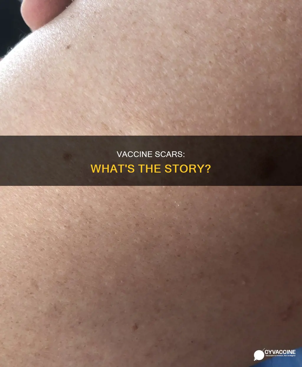 what is the vaccine that leaves a scar