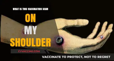 Understanding the Smallpox Vaccination Scar on Your Shoulder: History and Significance