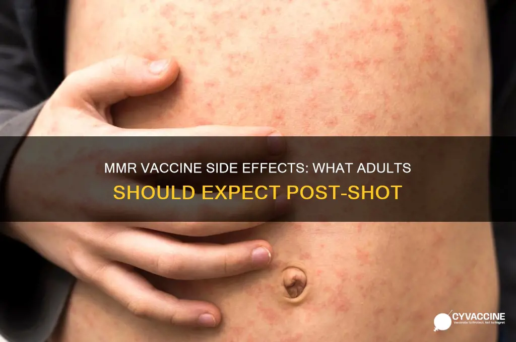 what to expect after mmr vaccine in adults