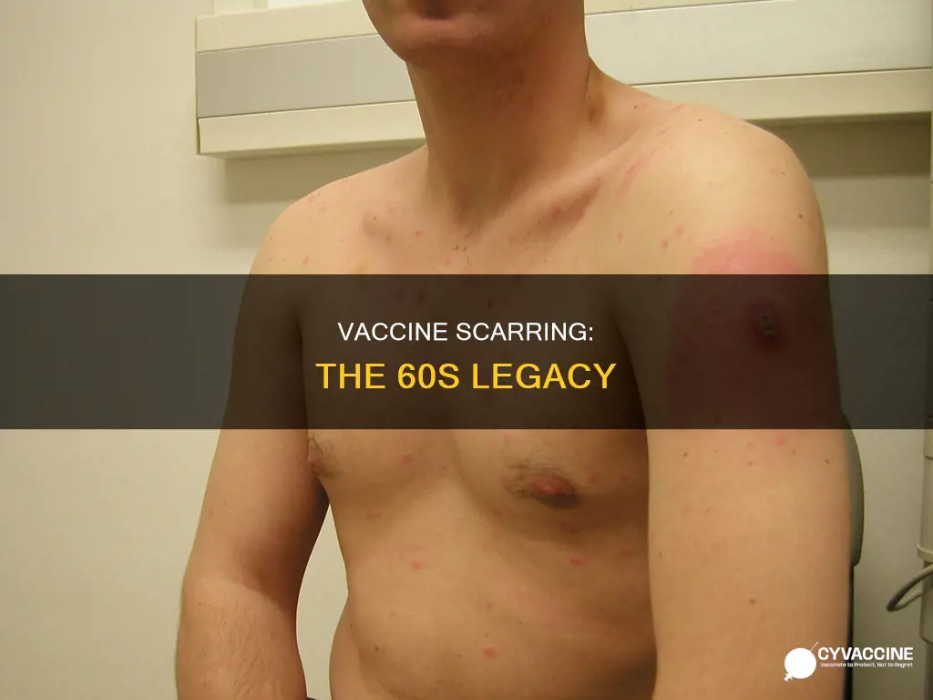 what vaccine in the 60s left a scar