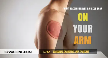 The Circular Scar Mystery: Which Vaccine Leaves a Mark?