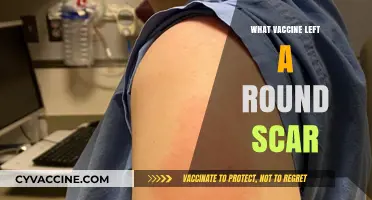 The Round Scar Mystery: Which Vaccine Left Its Mark?