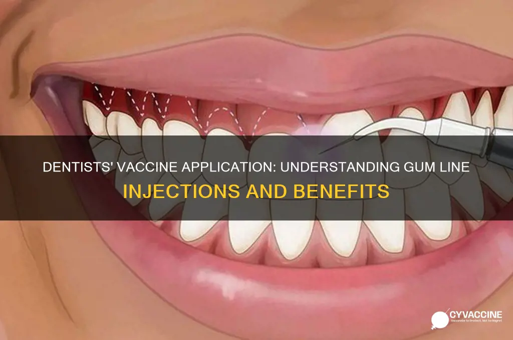 where do dentists vaccine on the gum line