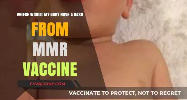 MMR Vaccine Rash: Common Causes and What to Expect for Your Baby