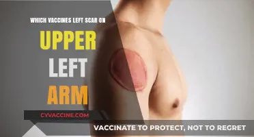 Vaccine Scars: Why the Upper Left Arm Bears the Mark?