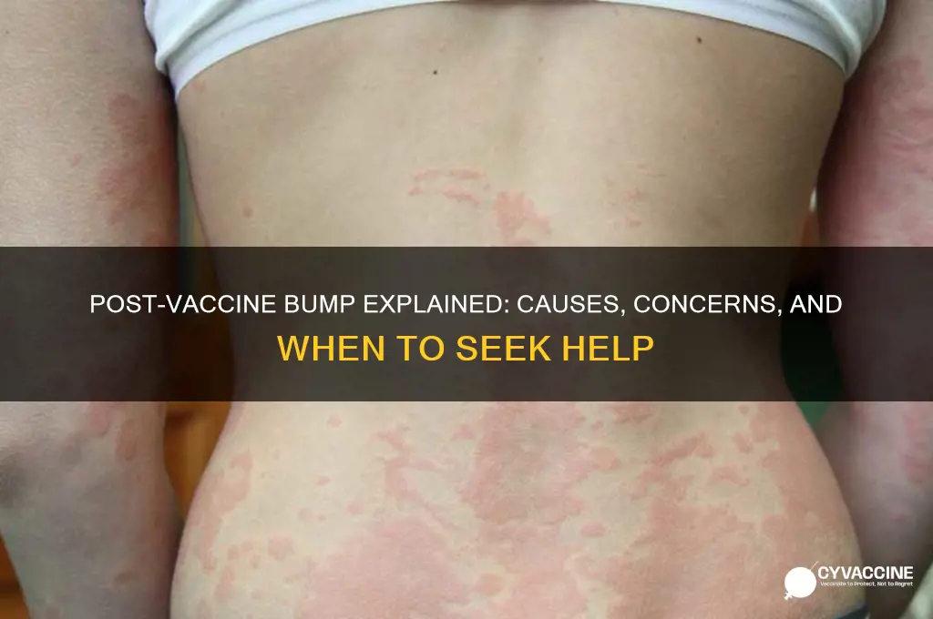 why do i have a bump after my vaccine