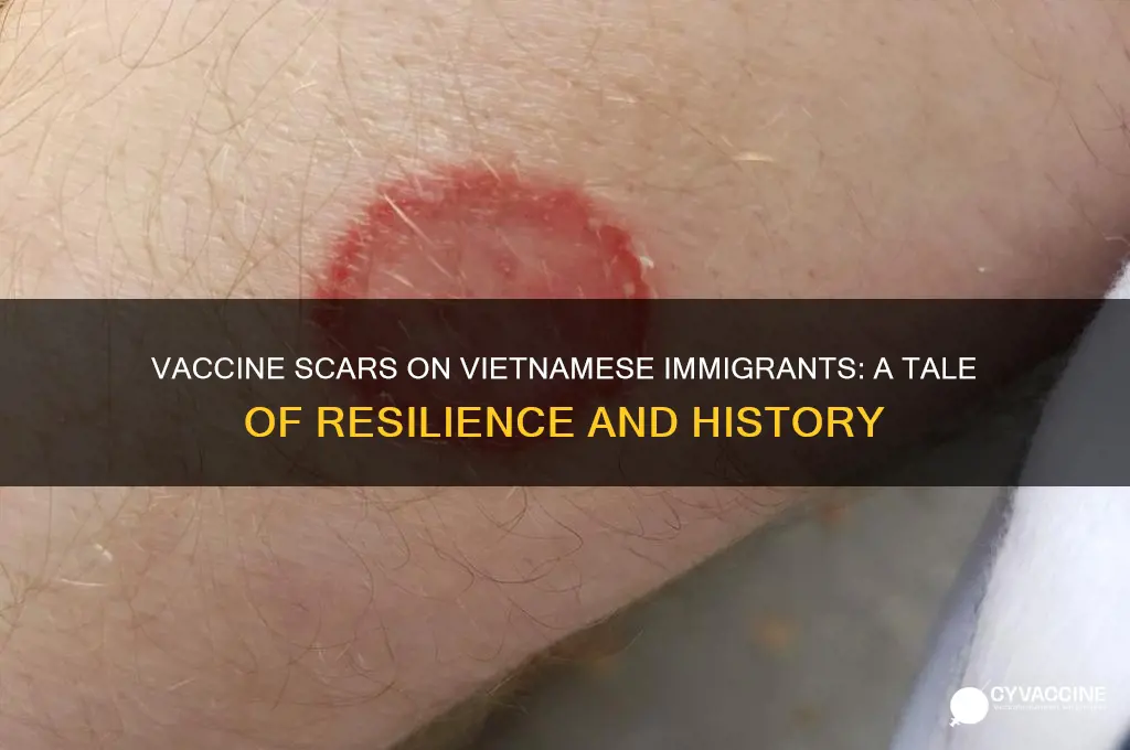 why immigrant vietnamese have vaccine scar on their arm